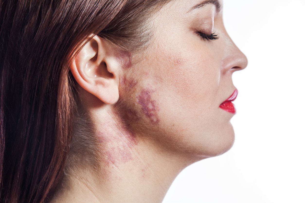 Port-wine stain treatment