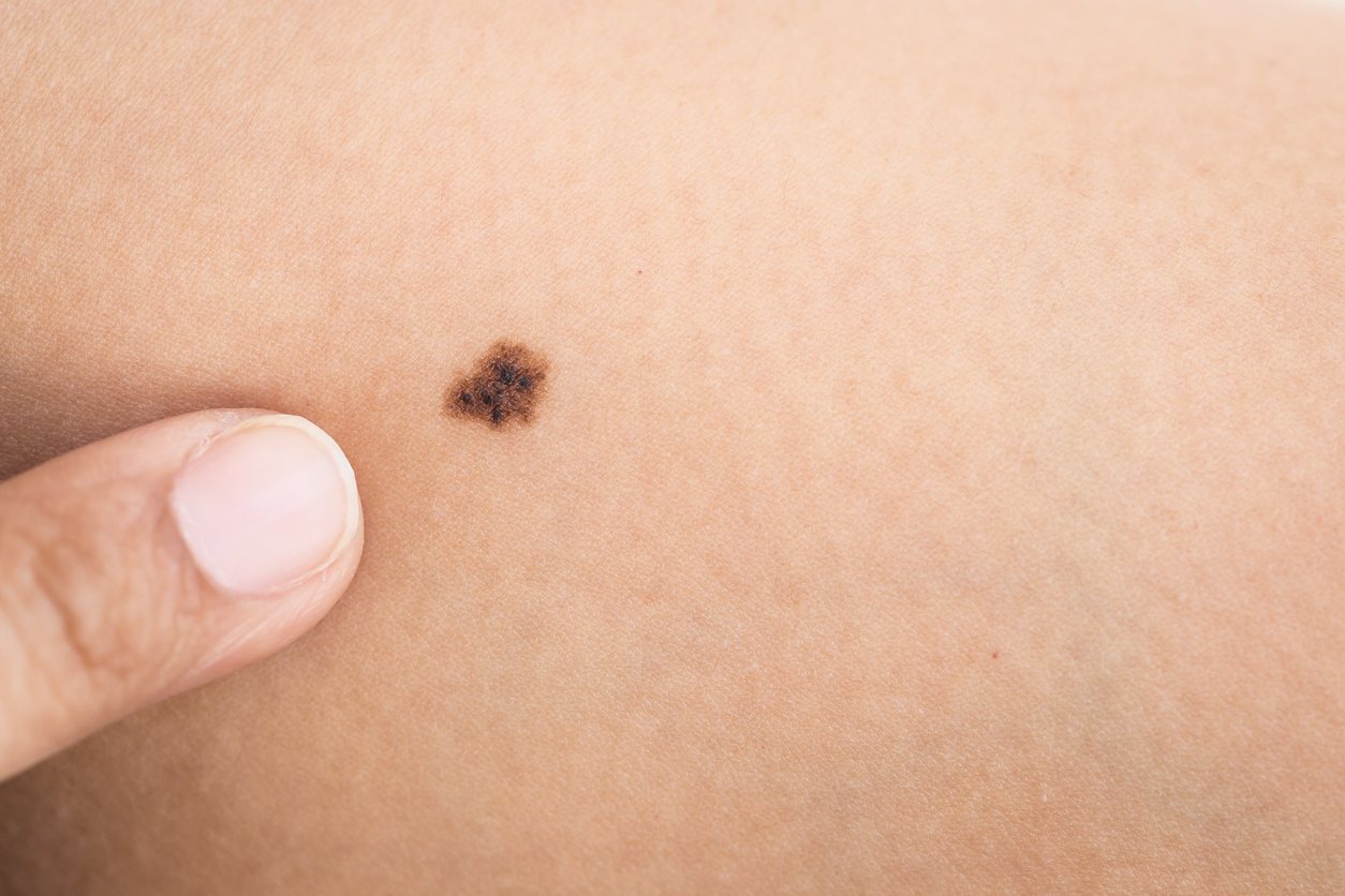 Brown and black moles